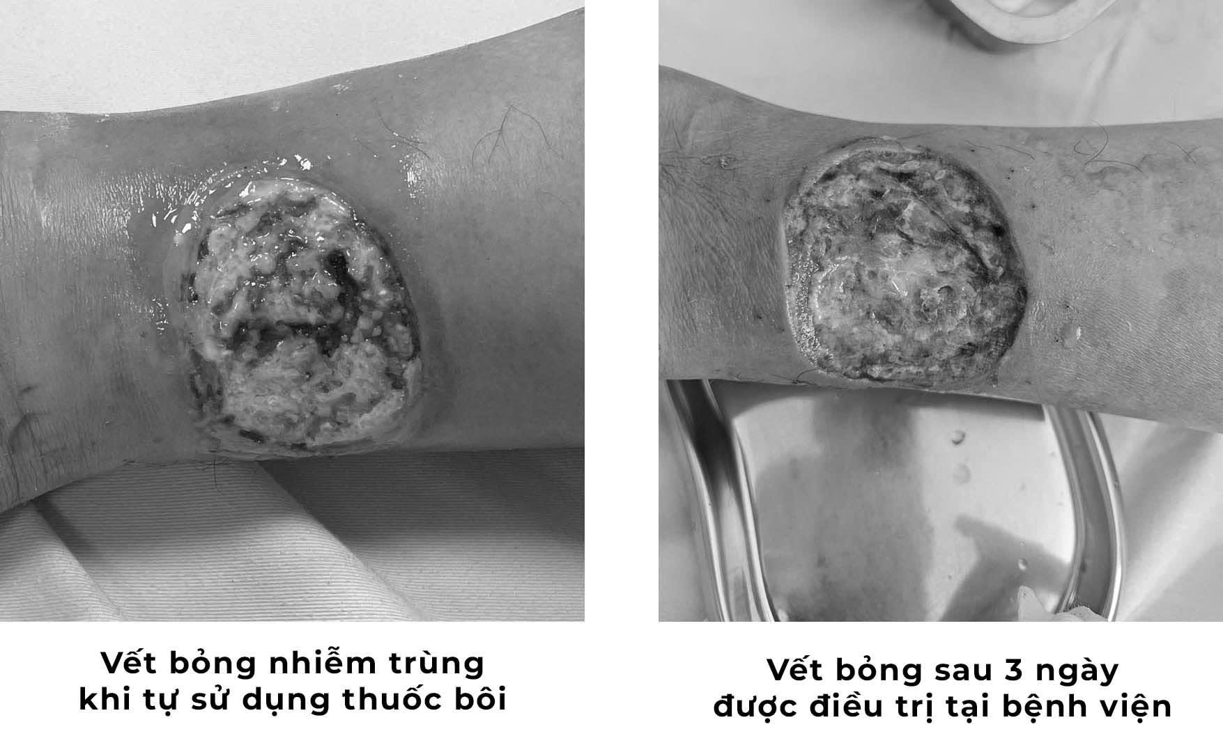 vet-bong-nhiem-trung-nang-khi-tu-y-su-dung-thuoc-boi-dan-gian-1778147094613768305234-1 Tự chữa bỏng bằng thuốc dân gian, người đàn ông suýt hoại tử chân- Ảnh 1.