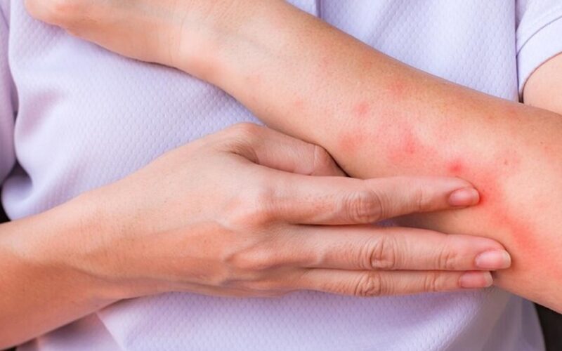 Nắng nóng khiến nguy cơ viêm da gia tăng, phòng ngừa thế nào?