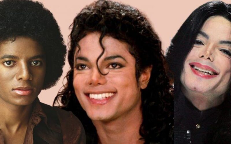 Sự thật về căn bệnh hiếm khiến Michael Jackson phải tẩy trắng da