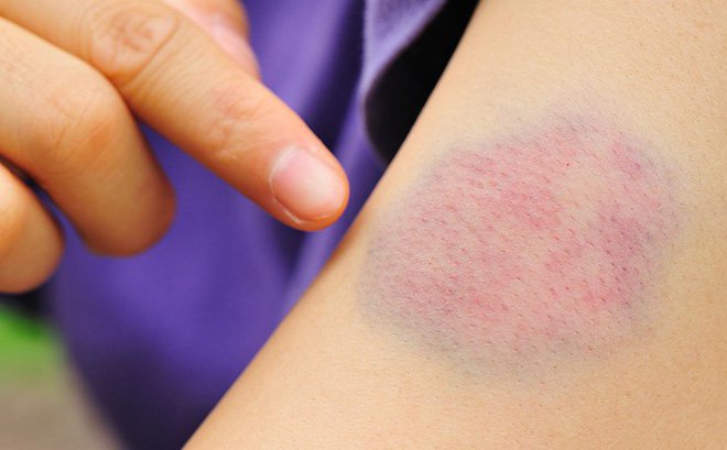 Xuất hiện nhiều vết bầm tím không rõ nguyên nhân cảnh giác với giảm tiểu cầu- Ảnh 1.