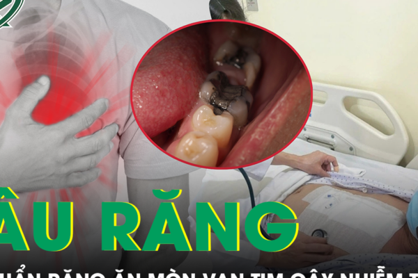 Hơn 10 chiếc răng sâu khiến người đàn ông 57 tuổi bị vi khuẩn ăn mòn van tim