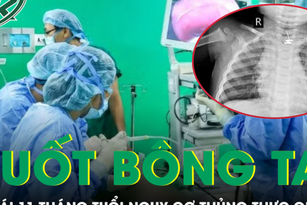 Nuốt phải bông tai kim loại, bé gái 11 tháng tuổi đối mặt nguy cơ thủng thực quản