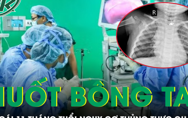 Nuốt phải bông tai kim loại, bé gái 11 tháng tuổi đối mặt nguy cơ thủng thực quản