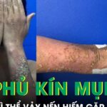 Da phủ kín mụn mủ, nữ bệnh nhân 28 tuổi suy kiệt vì thể vảy nến hiếm gặp