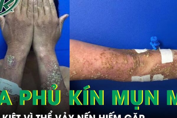 Da phủ kín mụn mủ, nữ bệnh nhân 28 tuổi suy kiệt vì thể vảy nến hiếm gặp
