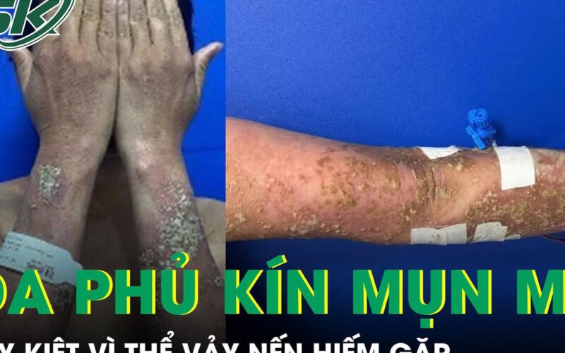 Da phủ kín mụn mủ, nữ bệnh nhân 28 tuổi suy kiệt vì thể vảy nến hiếm gặp