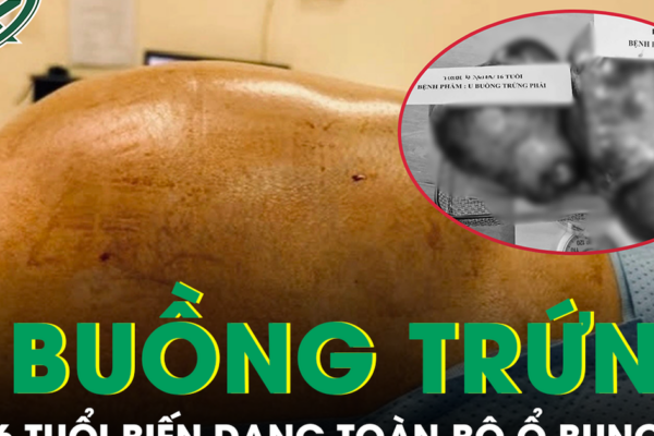 Bé gái 16 tuổi mang hai khối u buồng trứng khổng lồ gần 15kg, biến dạng toàn bộ ổ bụng