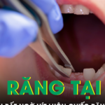 Được mẹ nhổ răng tại nhà, bé trai 9 tuổi bất ngờ hít luôn chiếc răng vào phổi