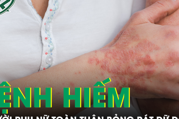 Căn bệnh hiếm khiến người phụ nữ sốt cao, toàn thân đỏ rực và bỏng rát dữ dội