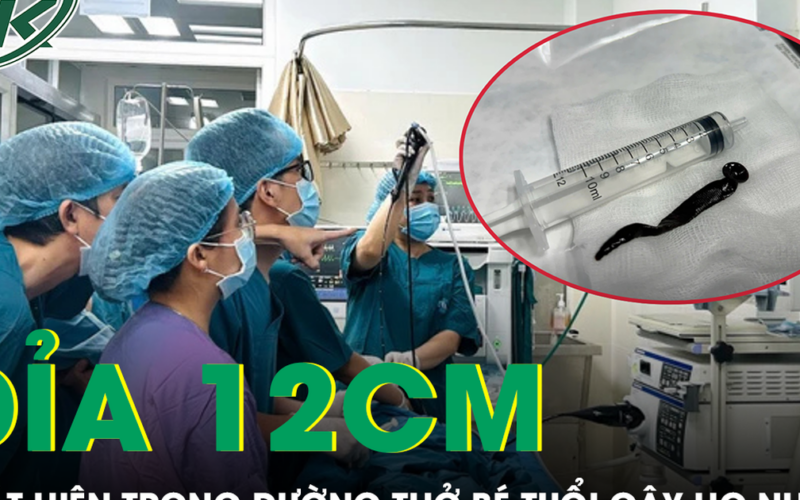 Bé 8 tuổi ho nhiều, bác sĩ phát hiện con đỉa dài hơn 12 cm trong đường thở