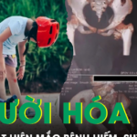 Bé gái cứng khớp suốt 2 năm sau cú ngã nhẹ, bác sĩ phát hiện mắc bệnh ‘người hóa đá’