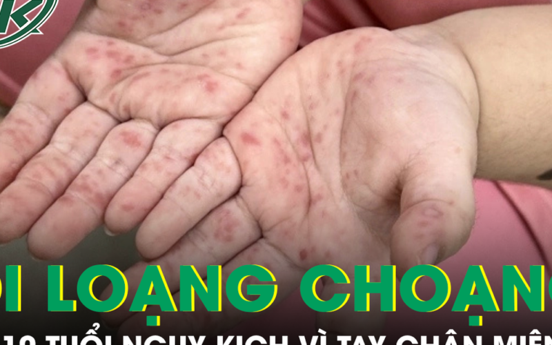 Tưởng bệnh nhẹ, bé gái 10 tuổi nhập viện nguy kịch vì tay chân miệng biến chứng thần kinh