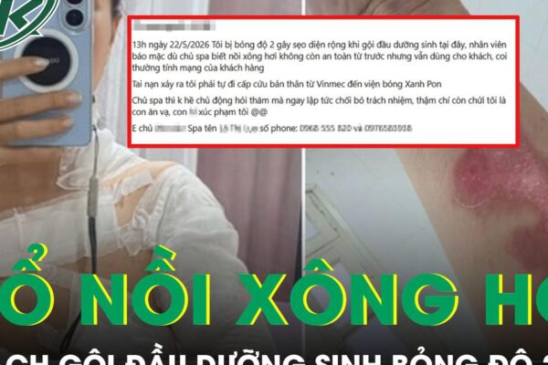 Nổ nồi xông hơi khi gội đầu dưỡng sinh, nữ khách bỏng độ 2 vùng cổ và ngực
