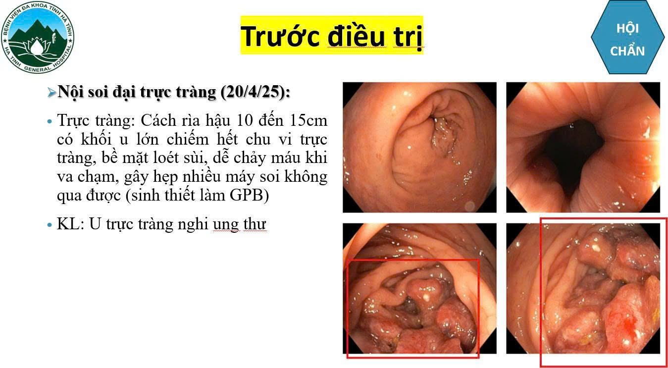 Bệnh viện Đa khoa Hà Tĩnh điều trị thành công cho bệnh nhân ung thư trực tràng di căn gan giai đoạn 4- Ảnh 1.