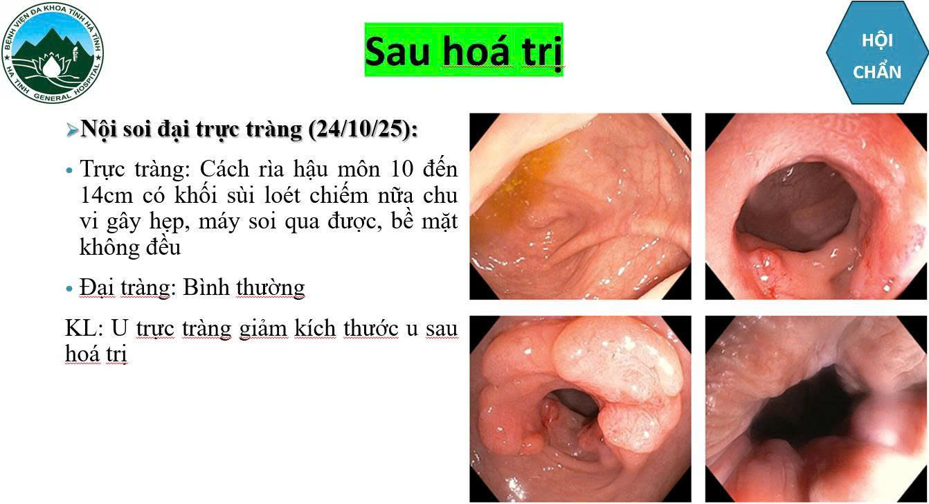 Bệnh viện Đa khoa Hà Tĩnh điều trị thành công cho bệnh nhân ung thư trực tràng di căn gan giai đoạn 4- Ảnh 2.