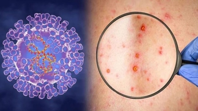 Bộ Y tế hướng dẫn cách phân loại bệnh truyền nhiễm nhóm A, B, C từ ngày 1/7- Ảnh 1.