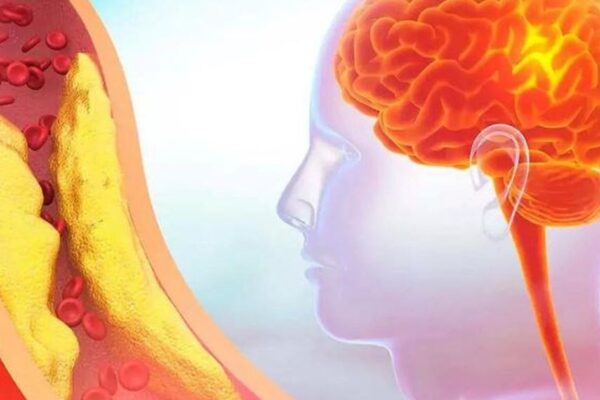 5 dấu hiệu cảnh báo thiếu máu não do hẹp động mạch cảnh