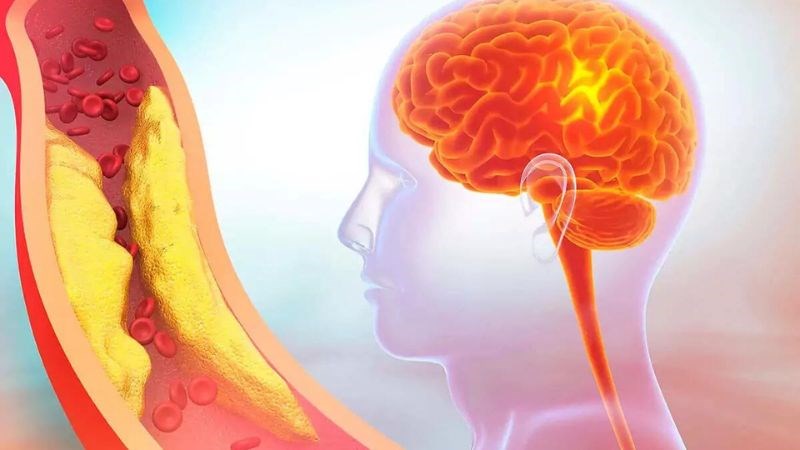 5 dấu hiệu cảnh báo thiếu máu não do hẹp động mạch cảnh- Ảnh 1.