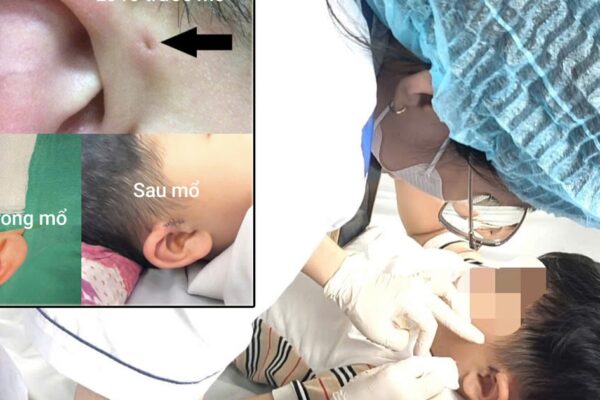 Hi hữu ca rò luân nhĩ di truyền qua 3 thế hệ