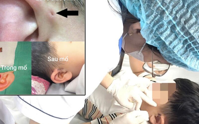 Hi hữu ca rò luân nhĩ di truyền qua 3 thế hệ