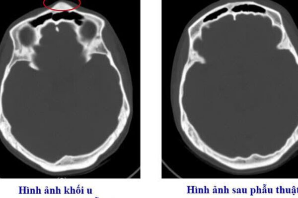 Bệnh viện Việt Nam – Thụy Điển Uông Bí phẫu thuật thành công ca u xương sọ hiếm gặp