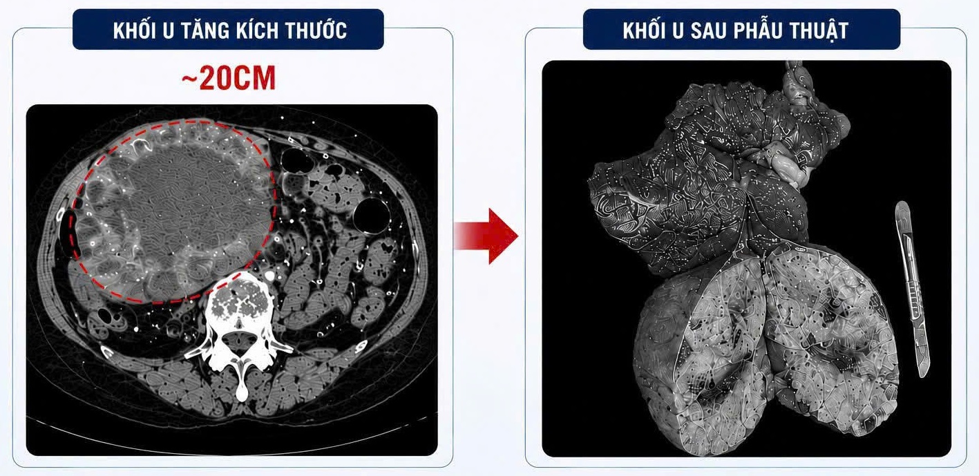 U gan 2 cm 'phình' lên 20 cm do tự điều trị bằng thuốc nam- Ảnh 1.