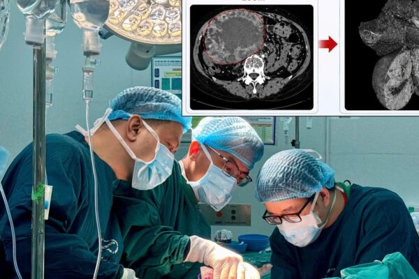 U gan 2 cm ‘phình’ lên 20 cm do tự điều trị bằng thuốc nam