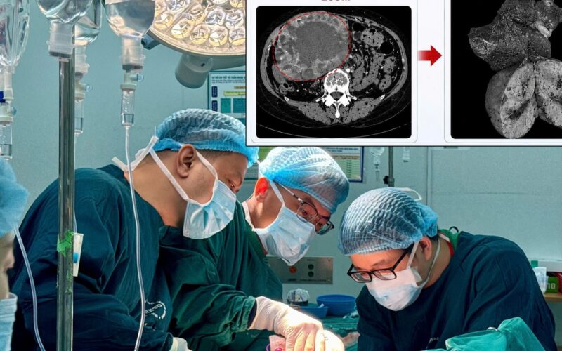 U gan 2 cm ‘phình’ lên 20 cm do tự điều trị bằng thuốc nam