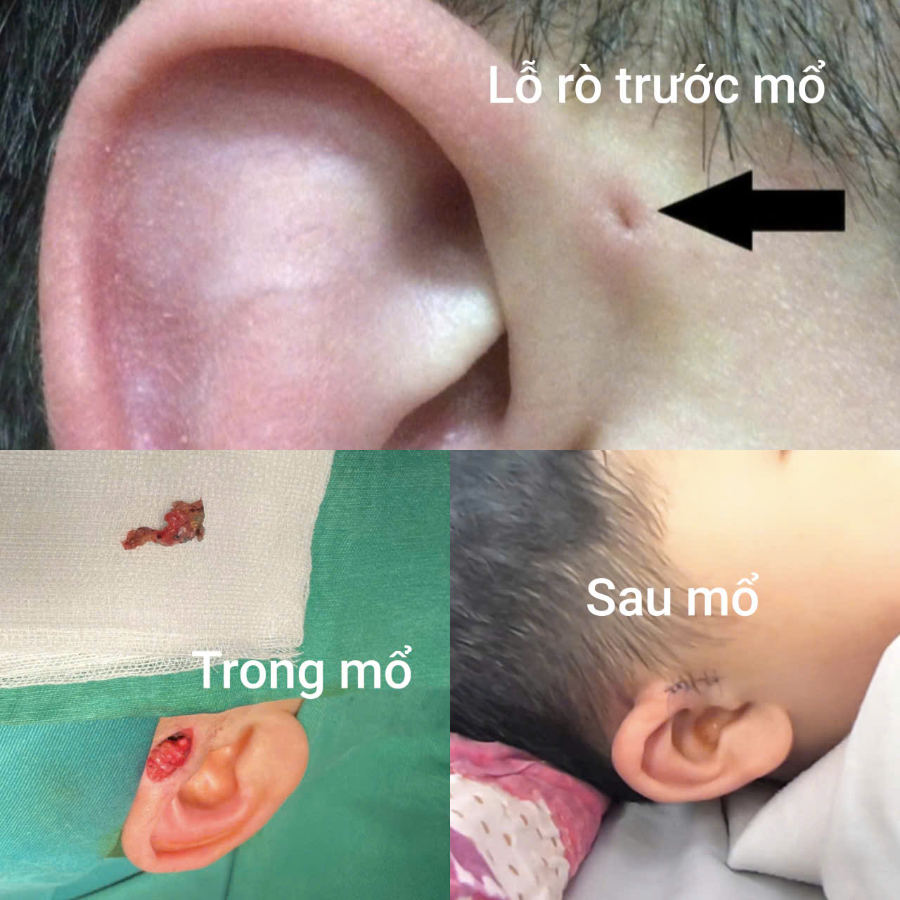 Hi hữu ca rò luân nhĩ di truyền qua 3 thế hệ- Ảnh 2.