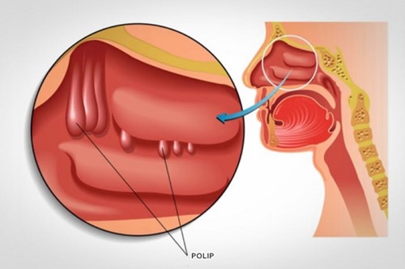 Nghẹt mũi, khó thở là biểu hiện của bệnh gì?- Ảnh 1.