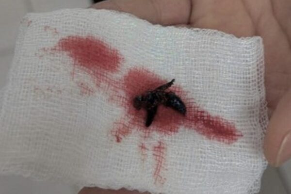 Người đàn ông 56 tuổi hoảng loạn vì ong vò vẽ sống trong tai