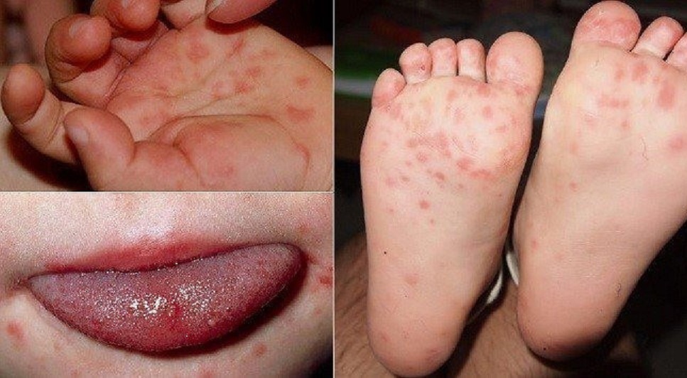 Khánh Hòa đã ghi nhận 2.254 ca tay chân miệng, bác sĩ khuyến cáo điều cần nhớ để phòng bệnh- Ảnh 1.