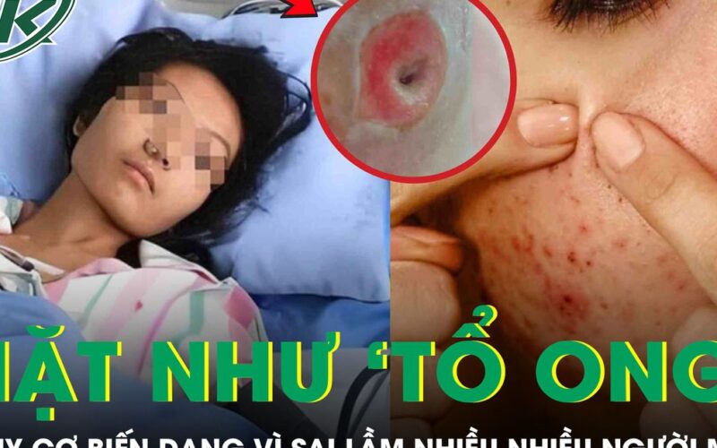 Người phụ nữ chết lặng khi thấy mặt như ‘tổ ong’, nguy cơ biến dạng vì sai lầm nhiều người mắc
