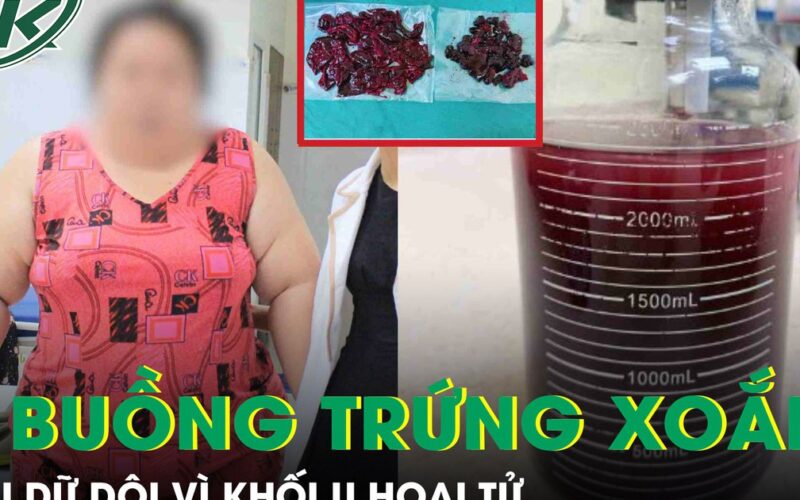 Cô gái nặng 120kg đau bụng dữ dội vì hoại tử khối u buồng trứng xoắn 20cm