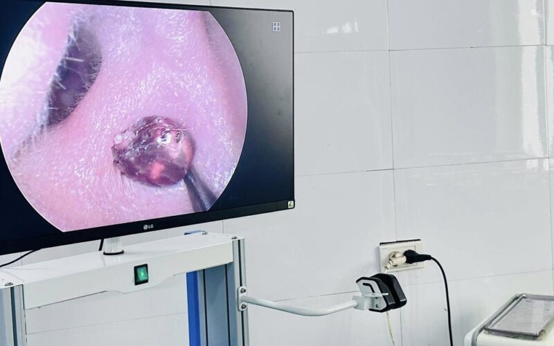 Đau nhức tai suốt một tuần, người phụ nữ tá hỏa vì ‘vị khách lạ’ trong tai