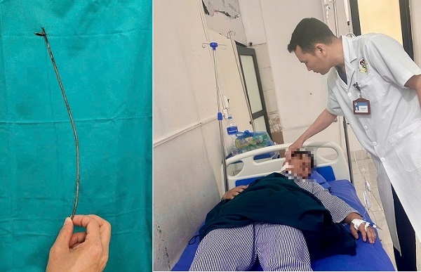 Nam thanh niên đi bắn cá bị mũi tên bật ngược đâm xuyên sâu 15cm vào vùng mặt- Ảnh 2.