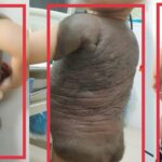 6 lần đại phẫu cắt bỏ khối u ‘mai rùa’ nặng trĩu trên lưng bé trai 7 tuổi