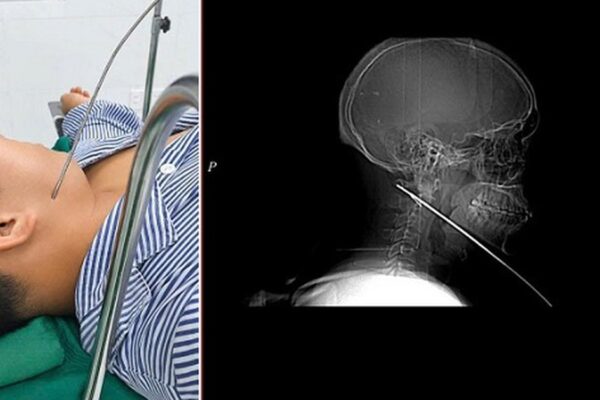 Nam thanh niên đi bắn cá bị mũi tên bật ngược đâm xuyên sâu 15cm vào vùng mặt