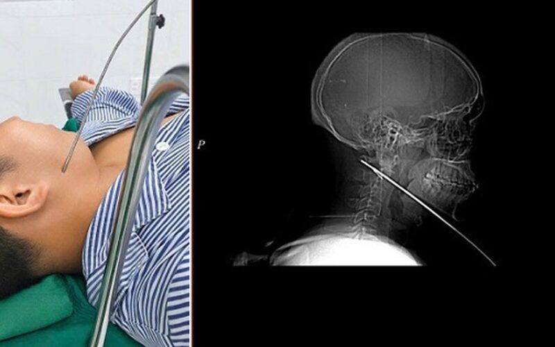Nam thanh niên đi bắn cá bị mũi tên bật ngược đâm xuyên sâu 15cm vào vùng mặt