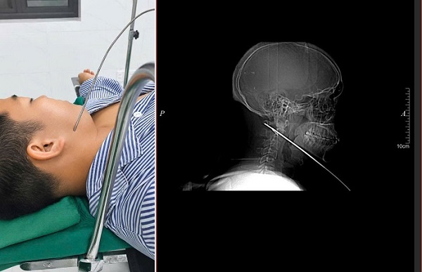 Nam thanh niên đi bắn cá bị mũi tên bật ngược đâm xuyên sâu 15cm vào vùng mặt- Ảnh 1.
